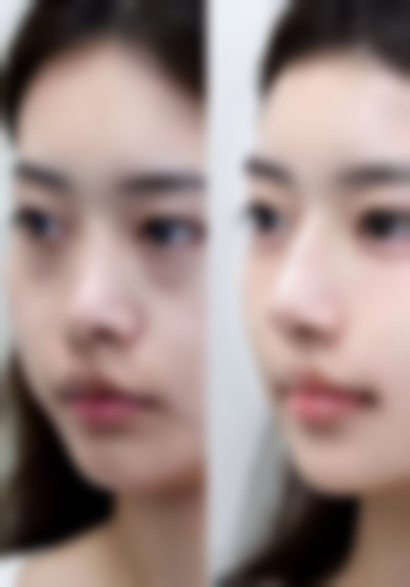韓國鼻整形真實心得：術前術後避坑指南（結合港澳生活習慣）