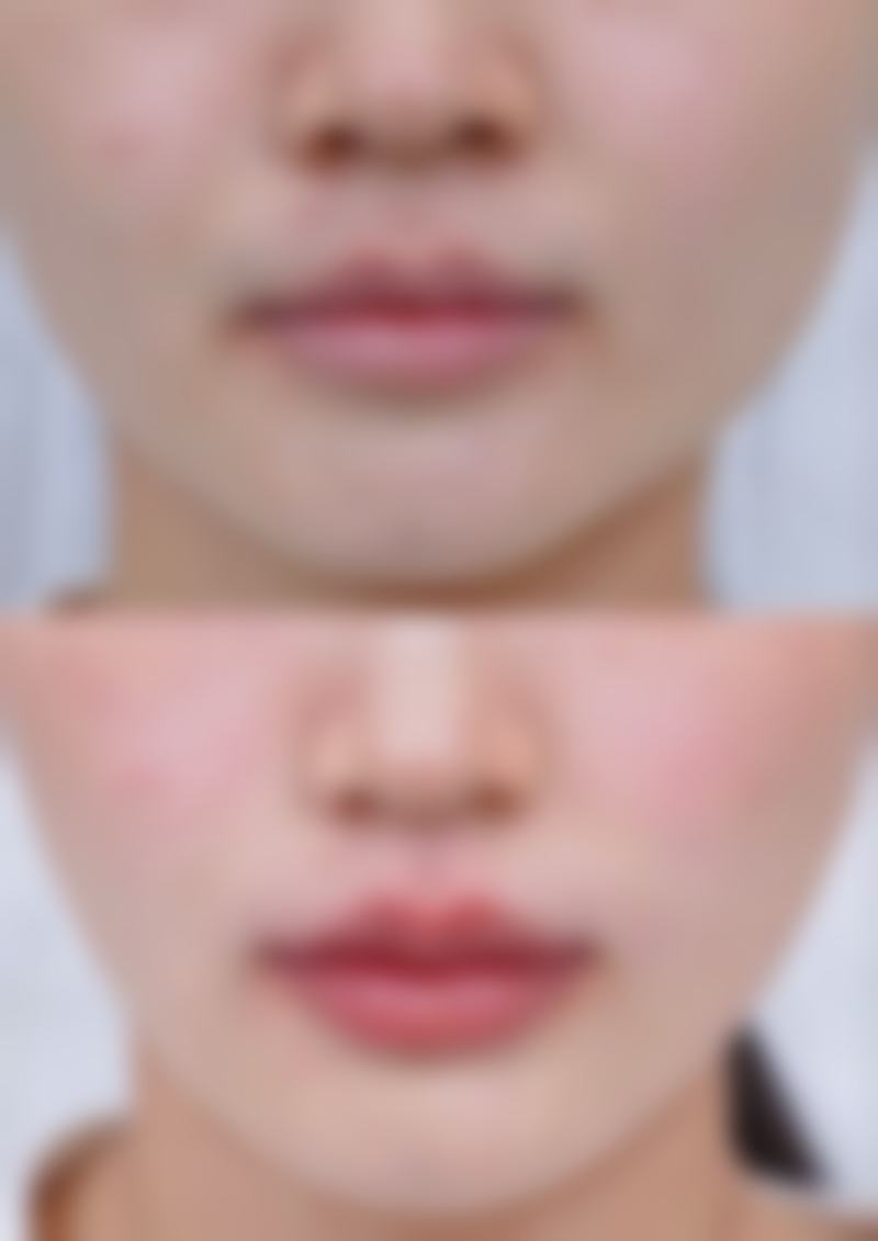 理性提醒：韓國鼻整形，揀對醫生先係關鍵！